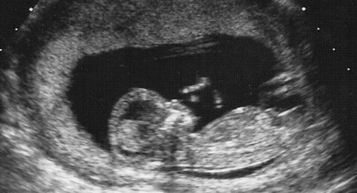 13ème semaine de grossesse