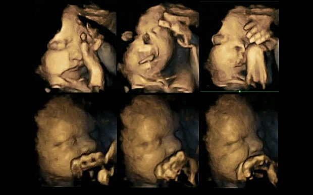 En haut, foetus dont la mère fume et en bas, foetus dont la mère ne fume pas.