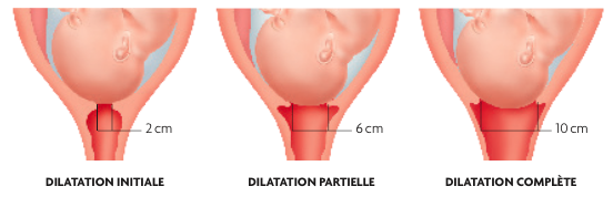 dilatation-du-col