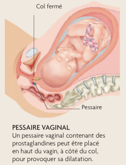 pessaire-vaginal