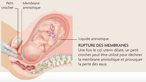 rupture-membranes