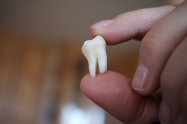 image-of-an-extracted-wisdom-tooth_t20_jxezbk