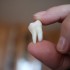 image-of-an-extracted-wisdom-tooth_t20_jxezbk